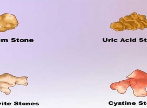 Bệnh sỏi thận có mấy loại? Thông tin đầy đủ về các loại sỏi thận